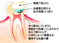 神経を残す治療法